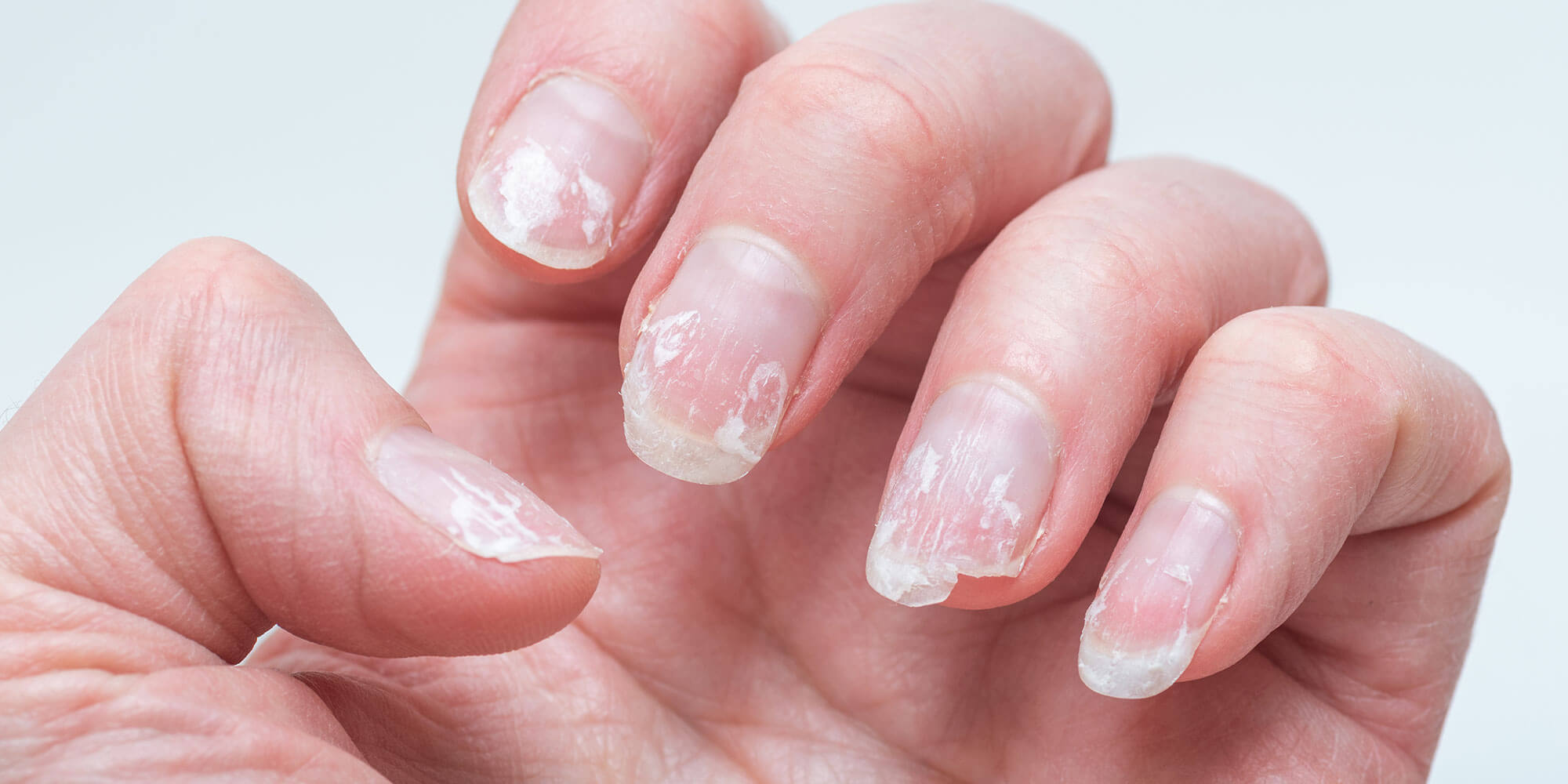 出血してしまう爪の例